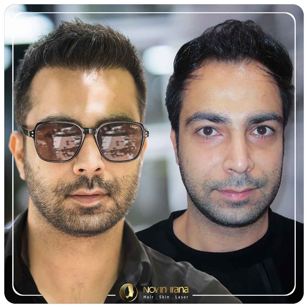 Hair Transplant