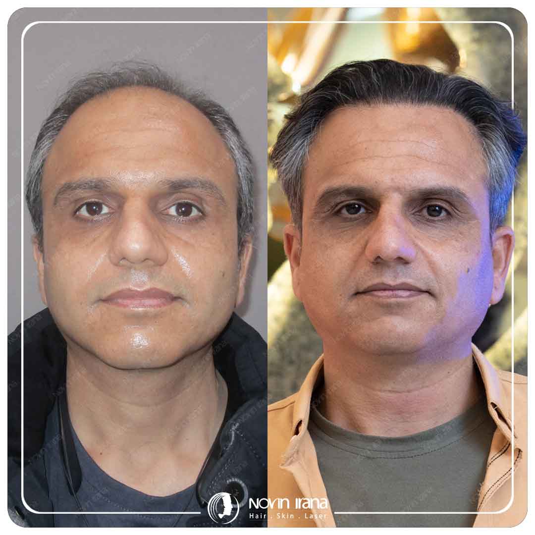 Hair Transplant