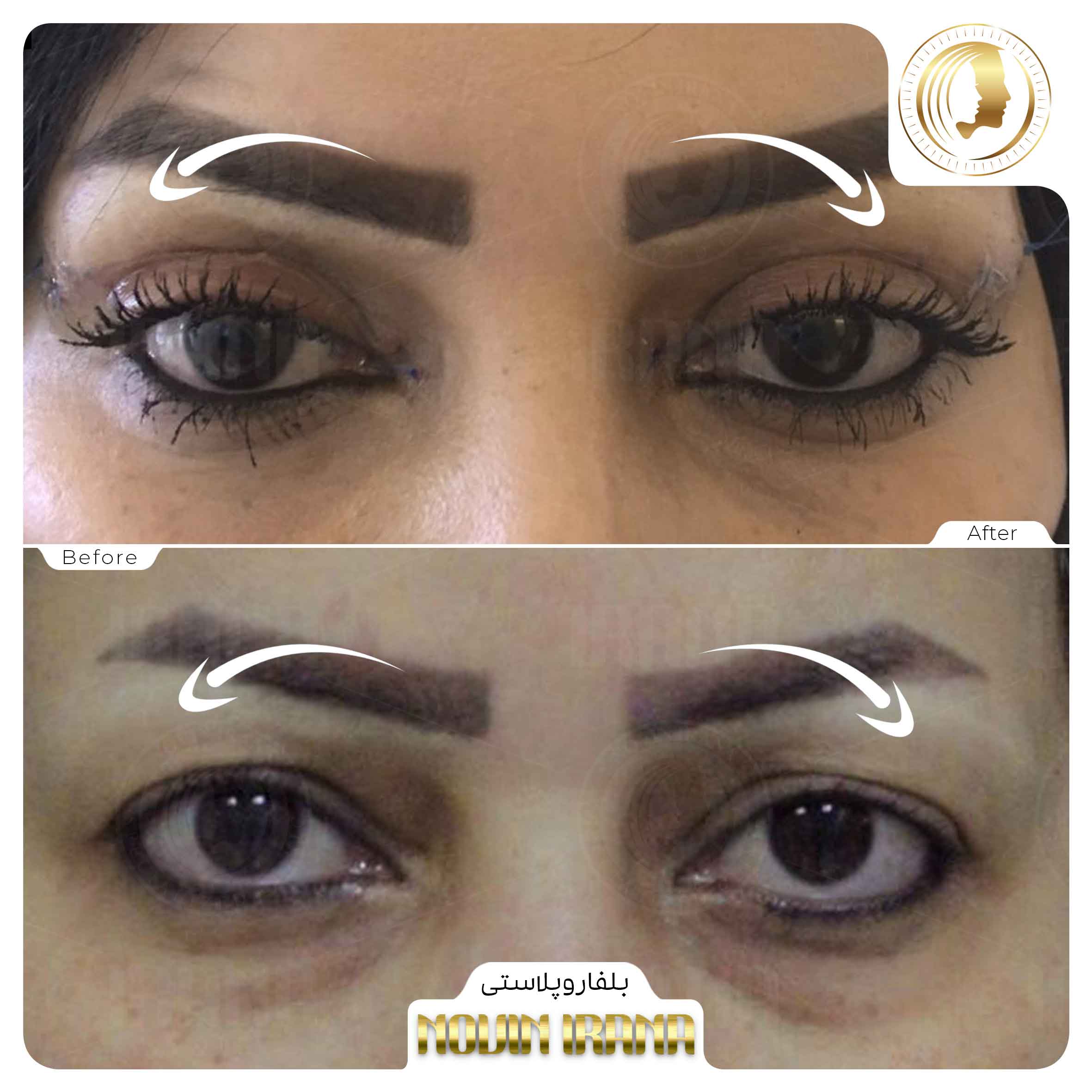 Blepharoplasty