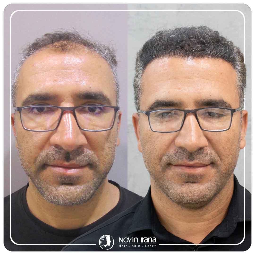 Hair Transplant