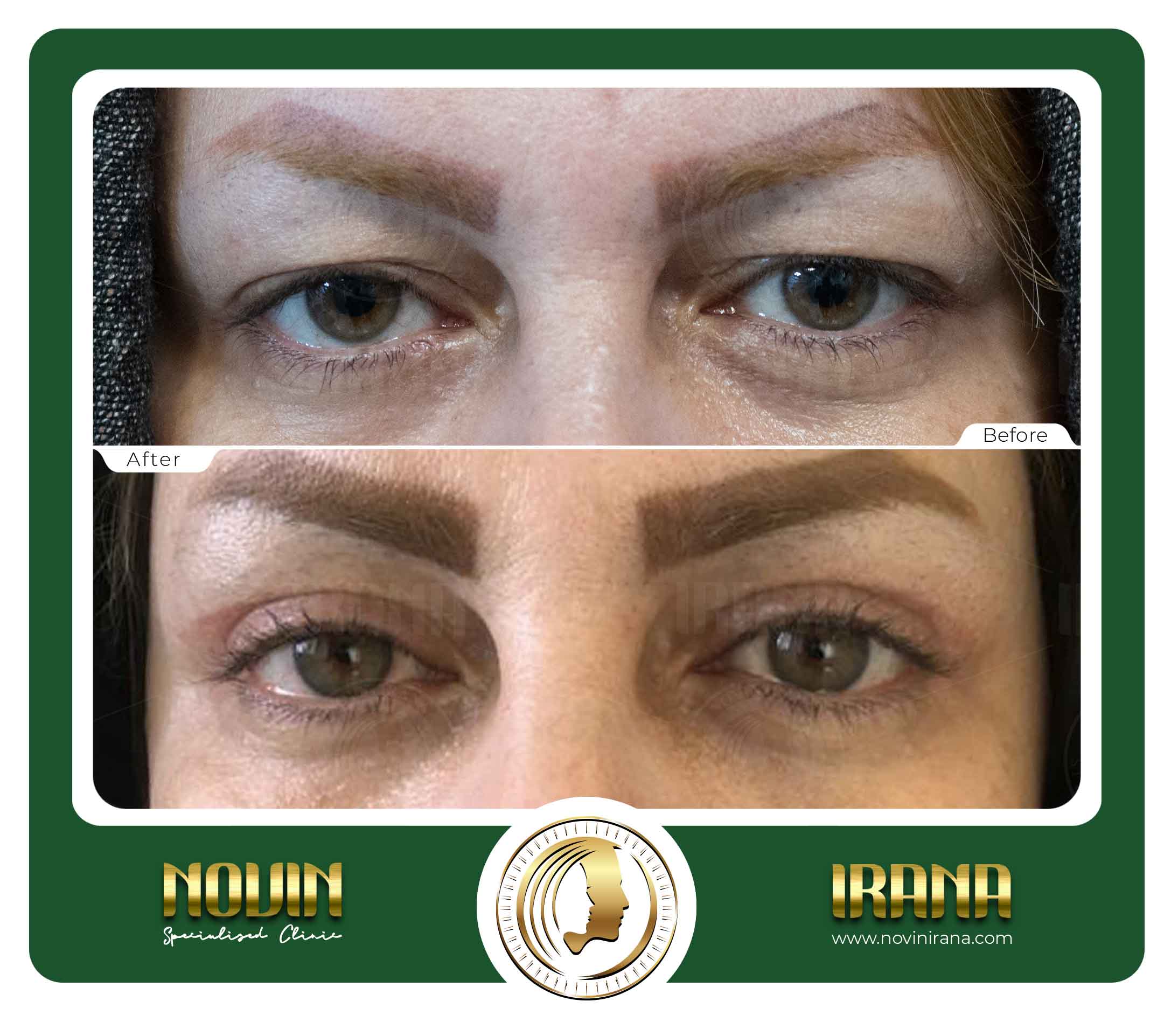 Blepharoplasty