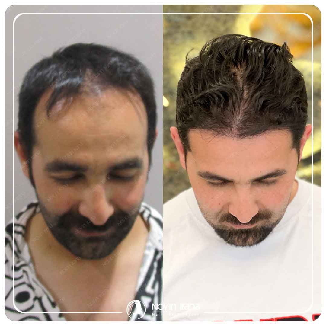 Hair Transplant
