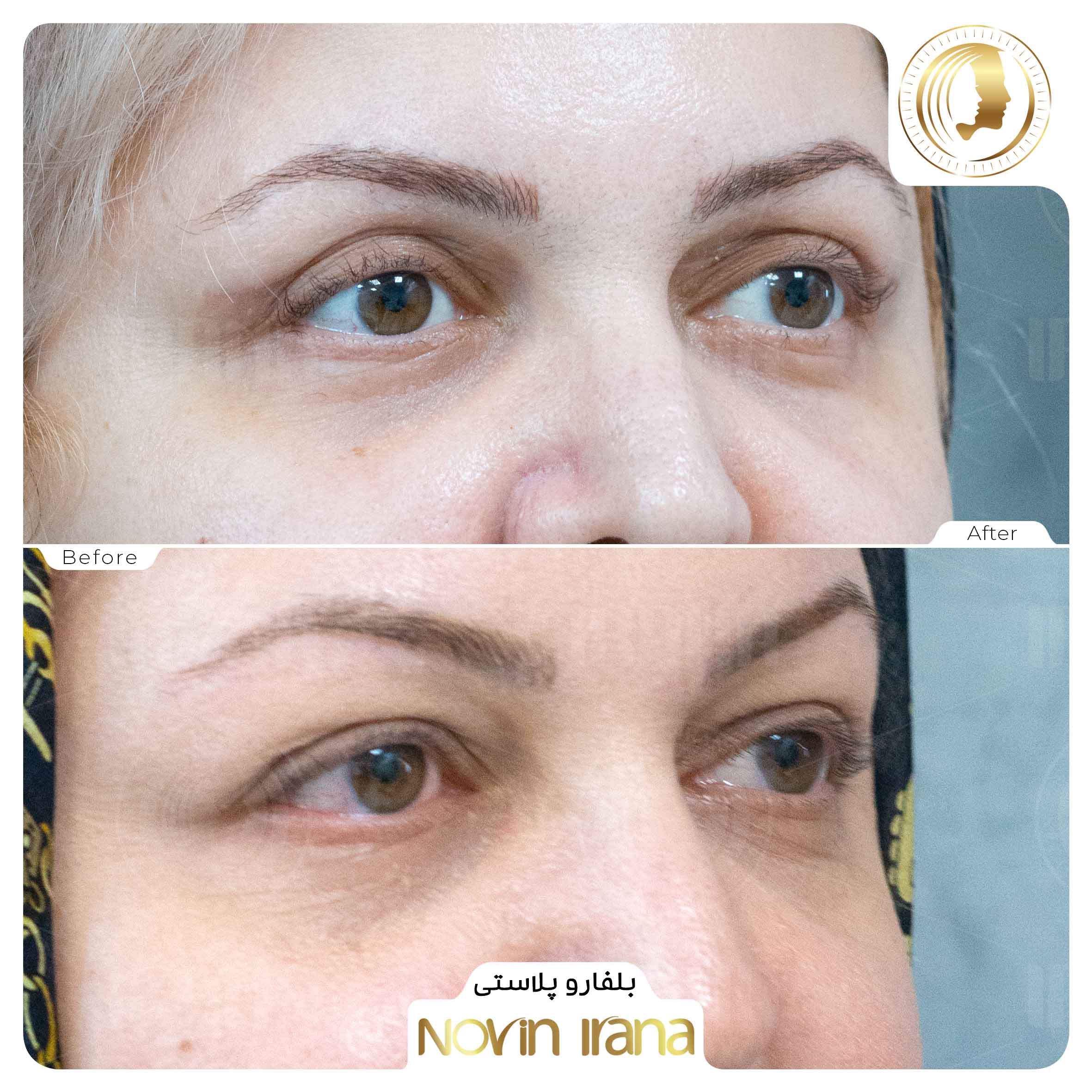 Blepharoplasty