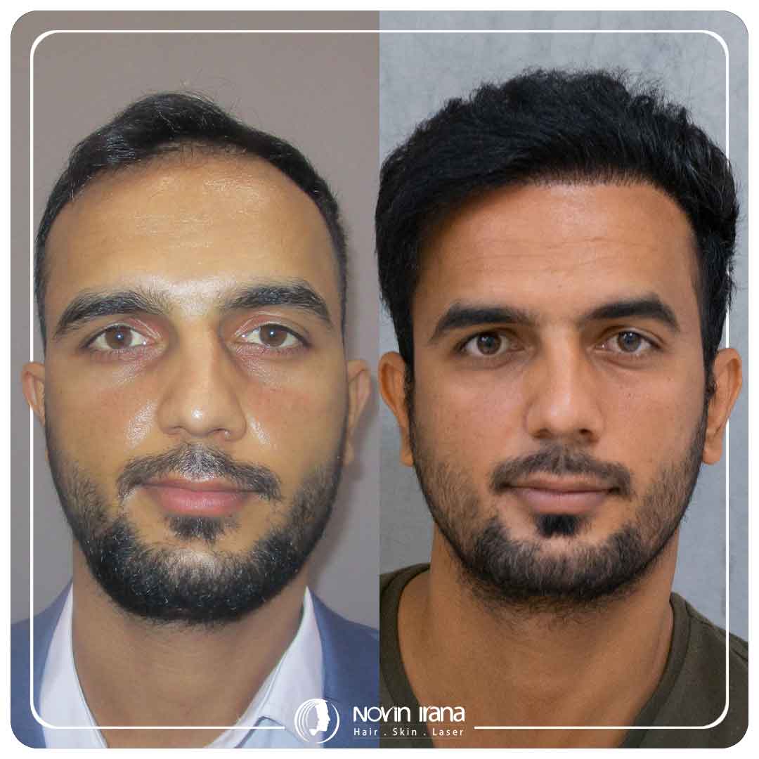 کاشت مو
