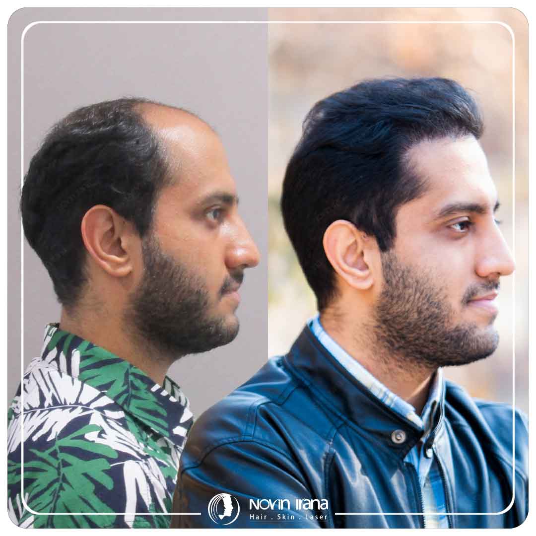 Hair Transplant