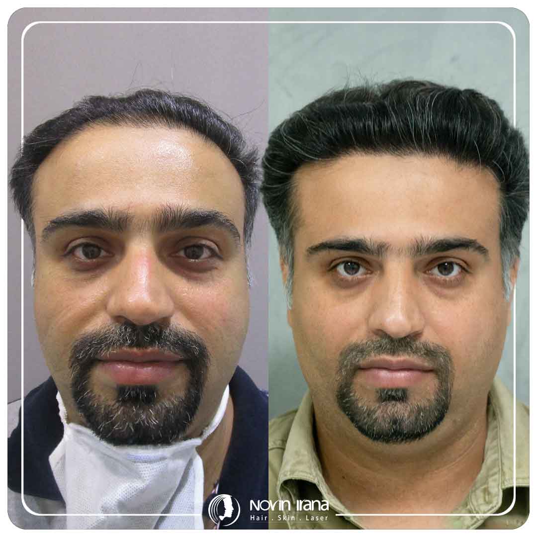 کاشت مو