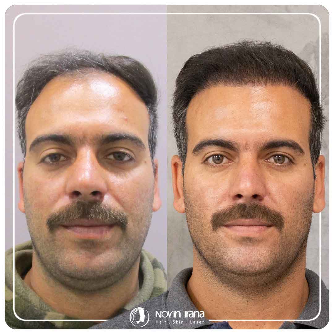 Hair Transplant