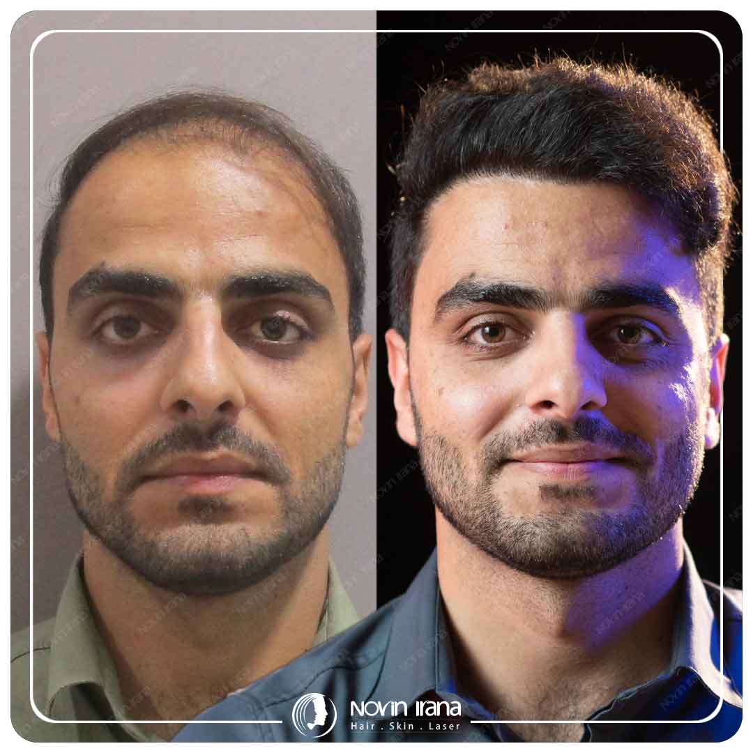 Hair Transplant