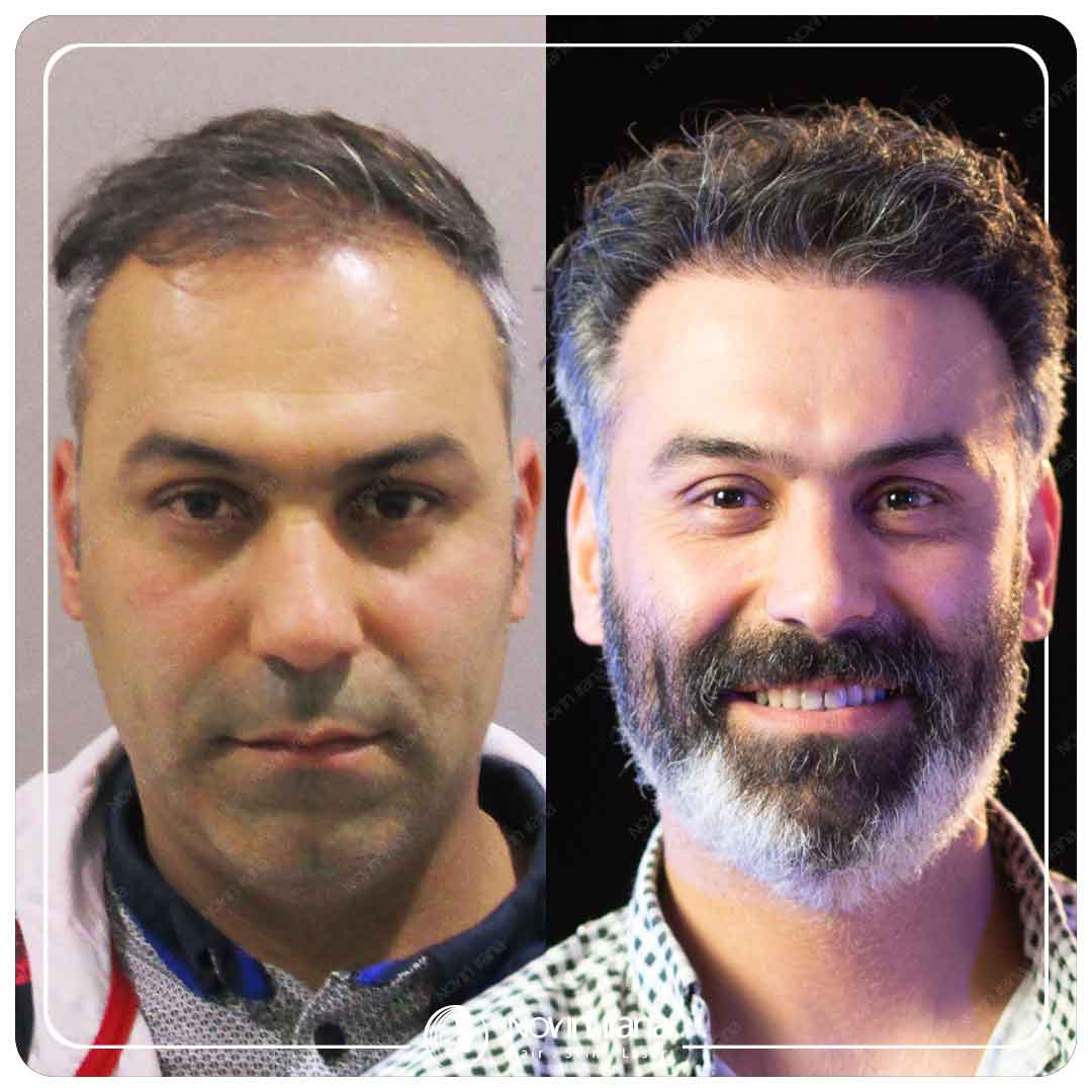 Hair Transplant