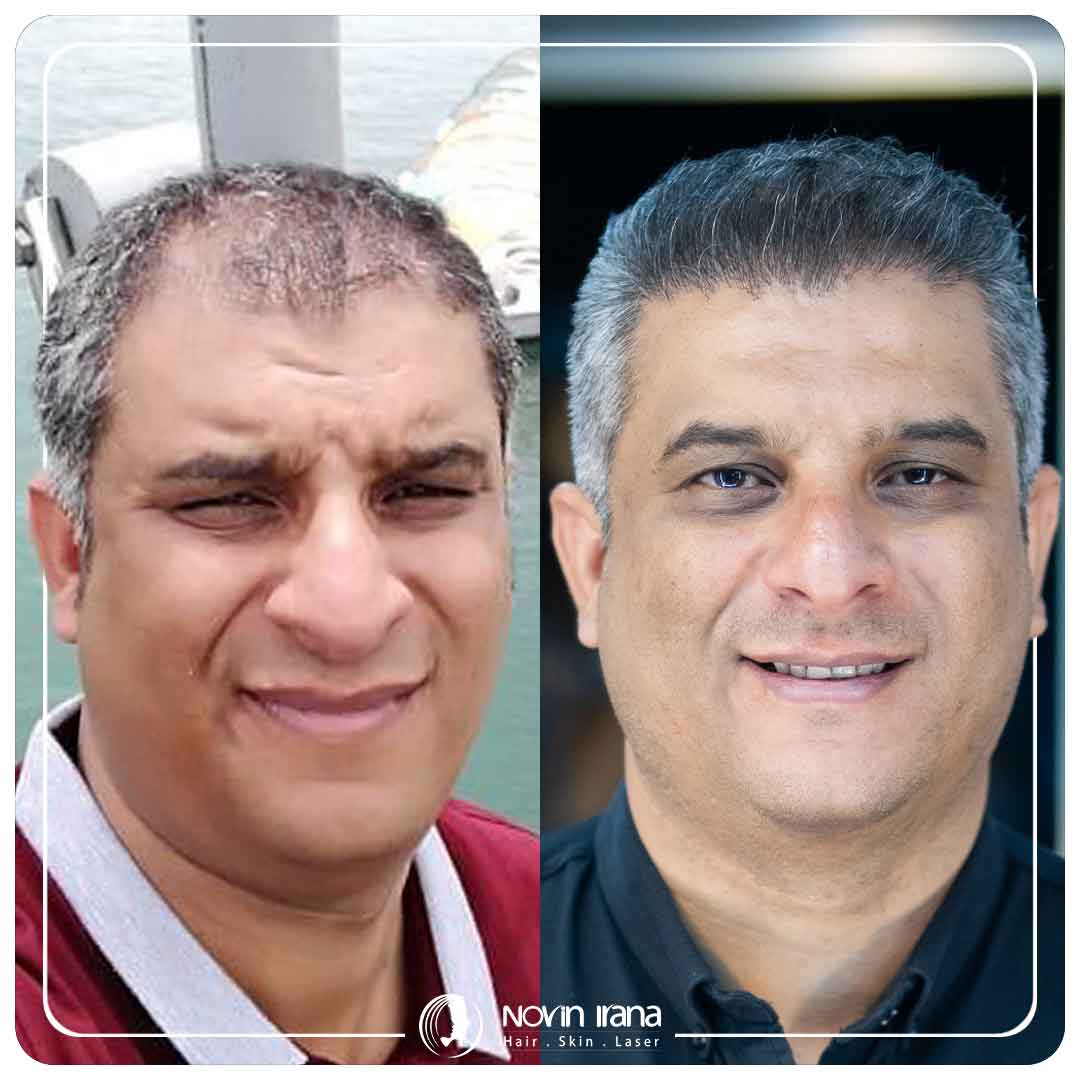 کاشت مو