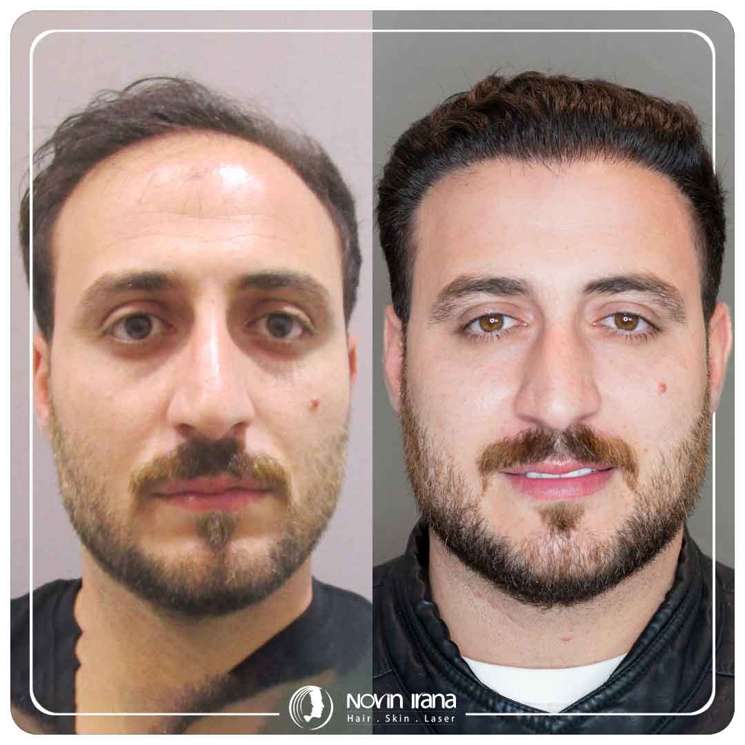 Hair Transplant
