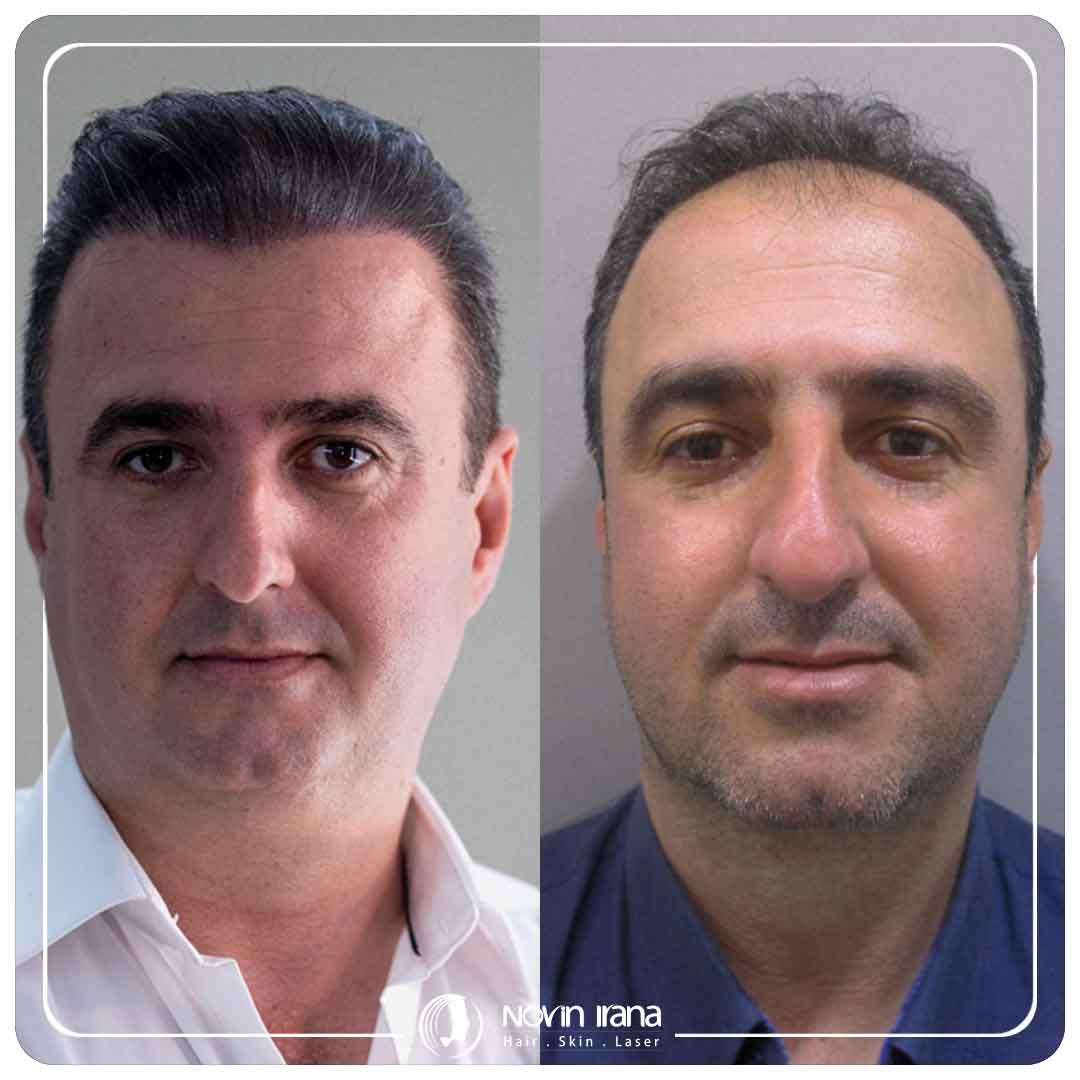 کاشت مو
