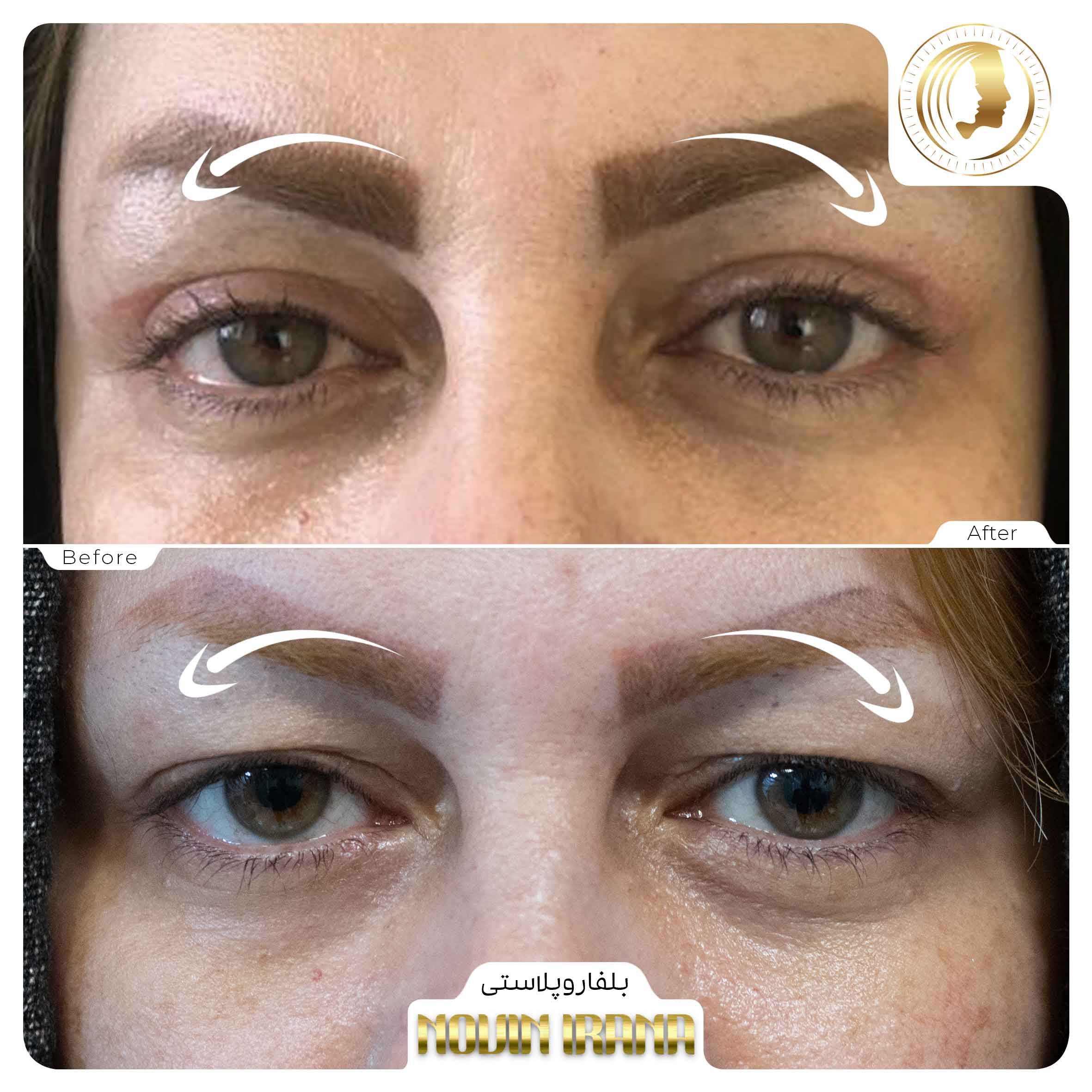 Blepharoplasty
