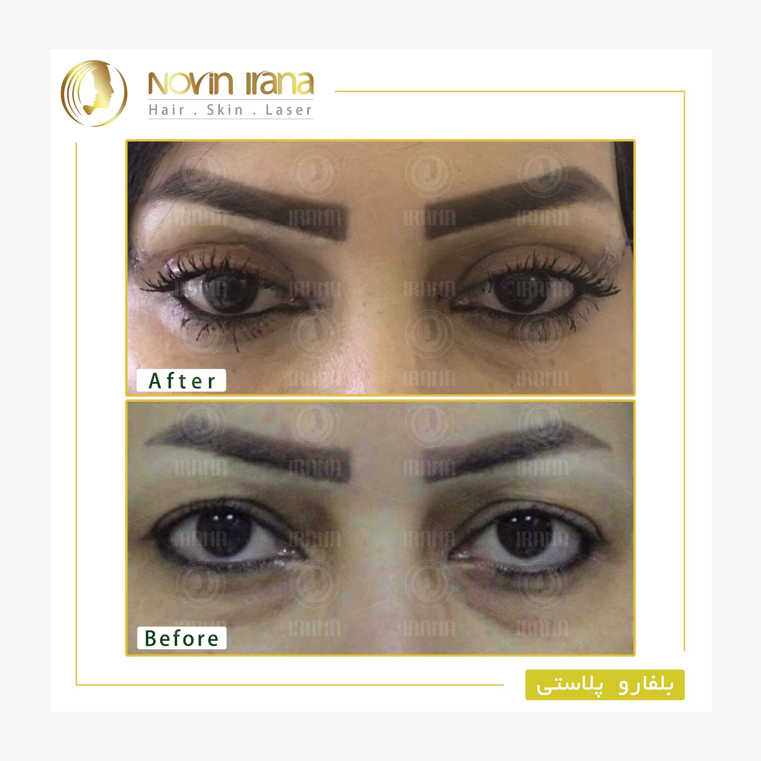 Blepharoplasty