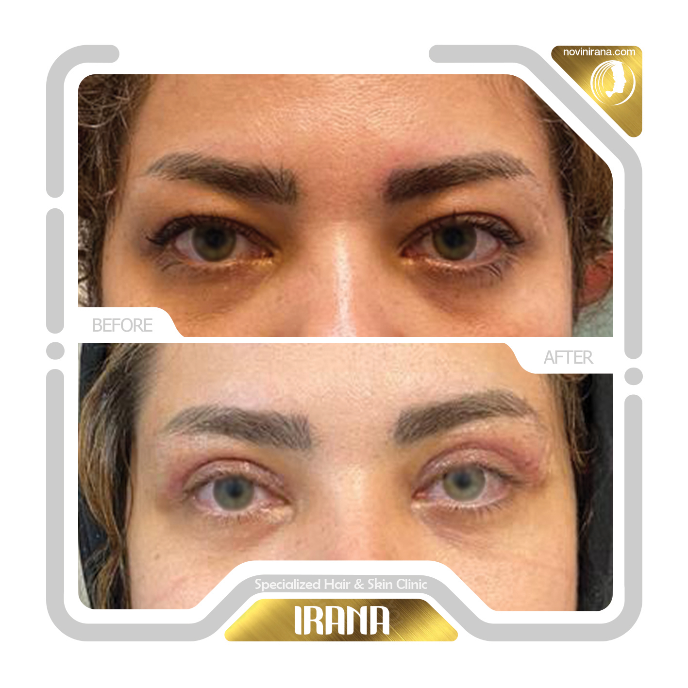 Blepharoplasty