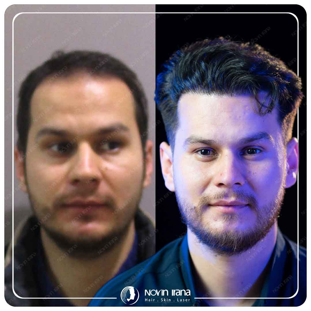 Hair Transplant