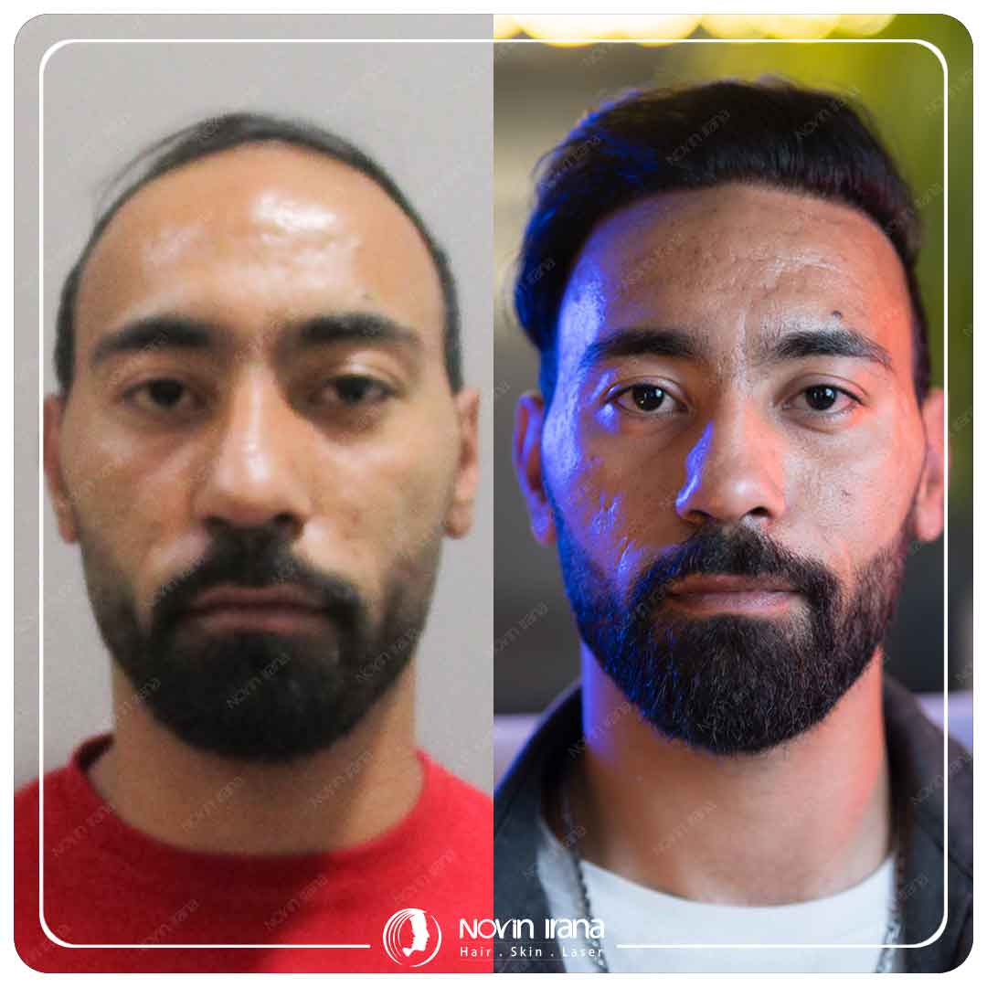 Hair Transplant