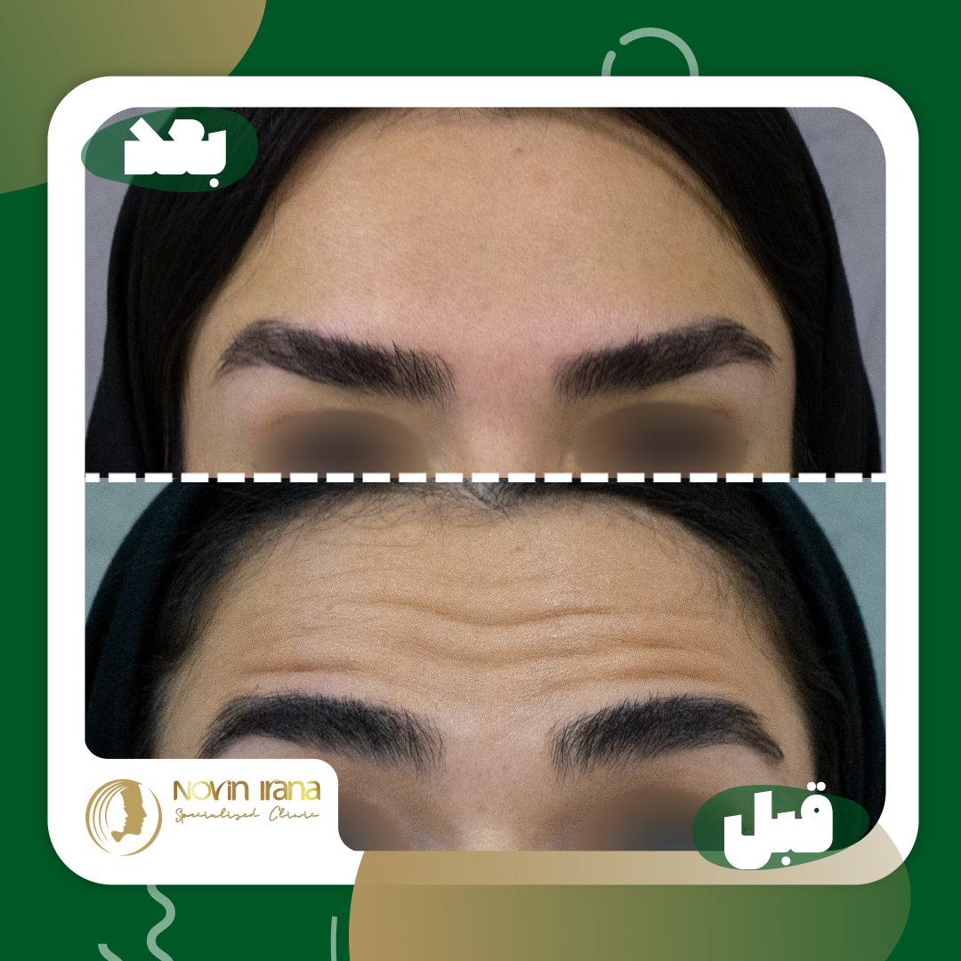 Botox