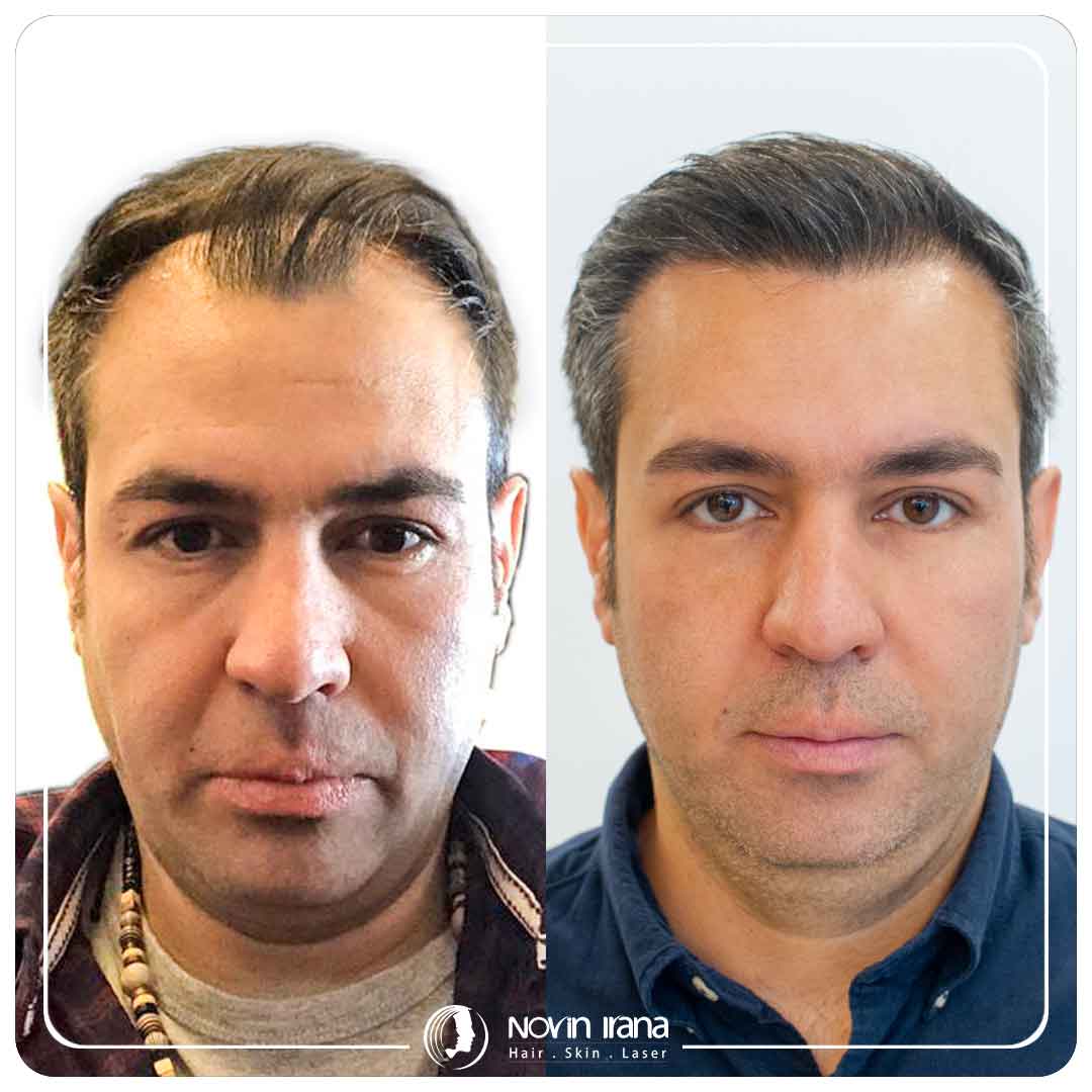 Hair Transplant