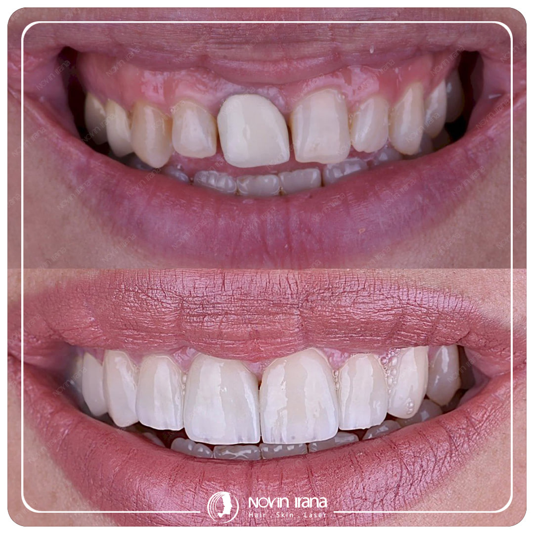 Hollywood smile
