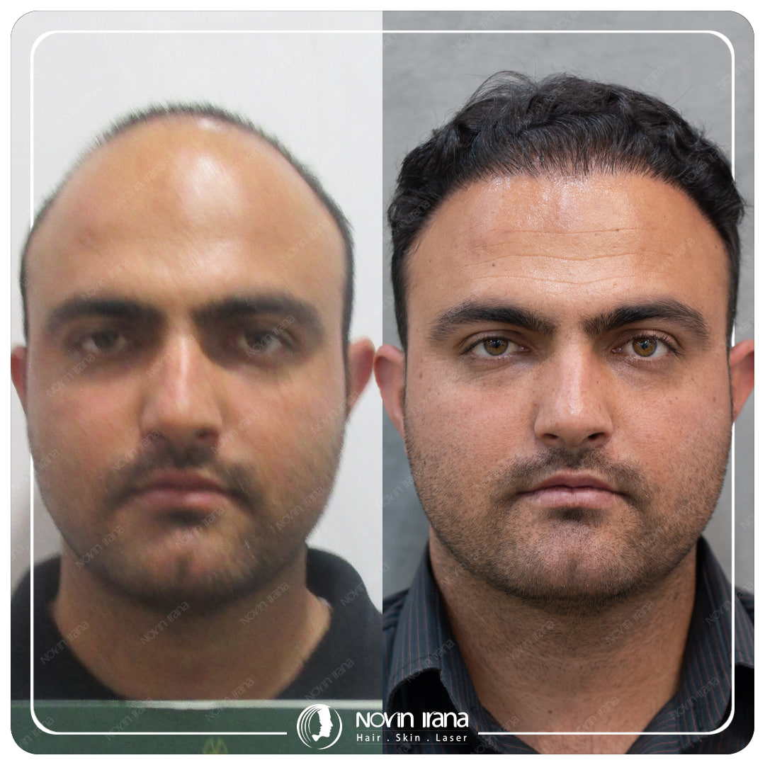 Hair Transplant