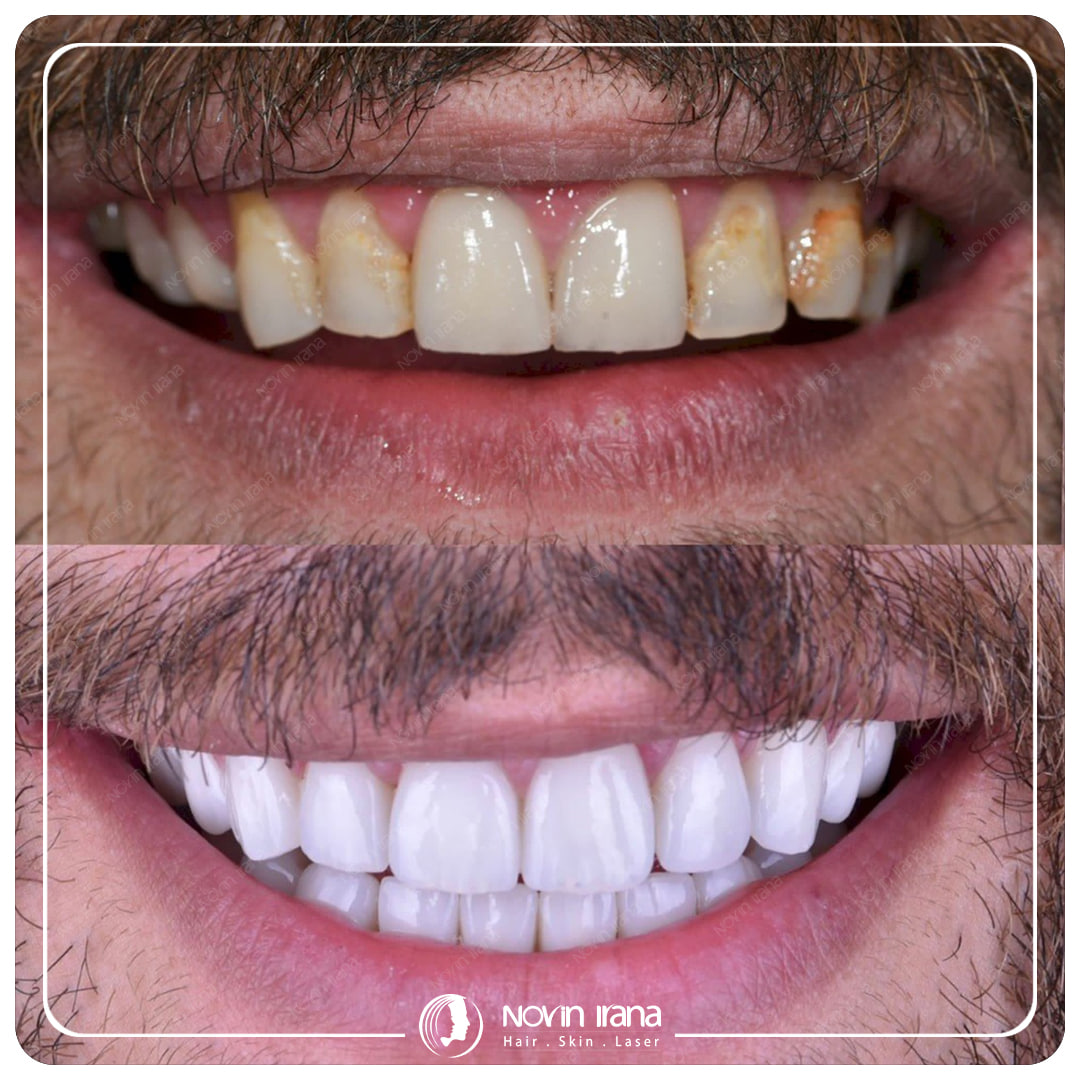 Hollywood smile