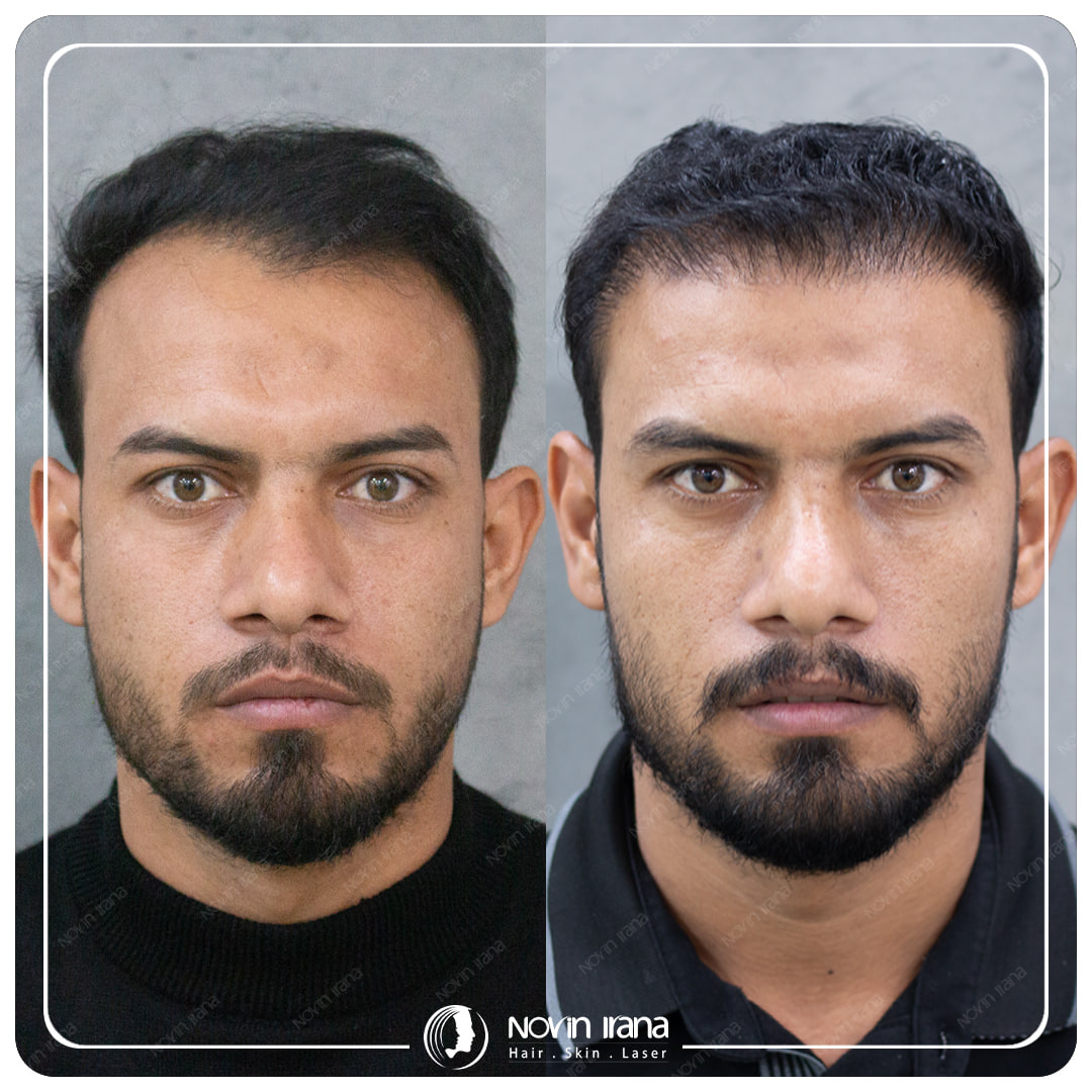 Hair Transplant
