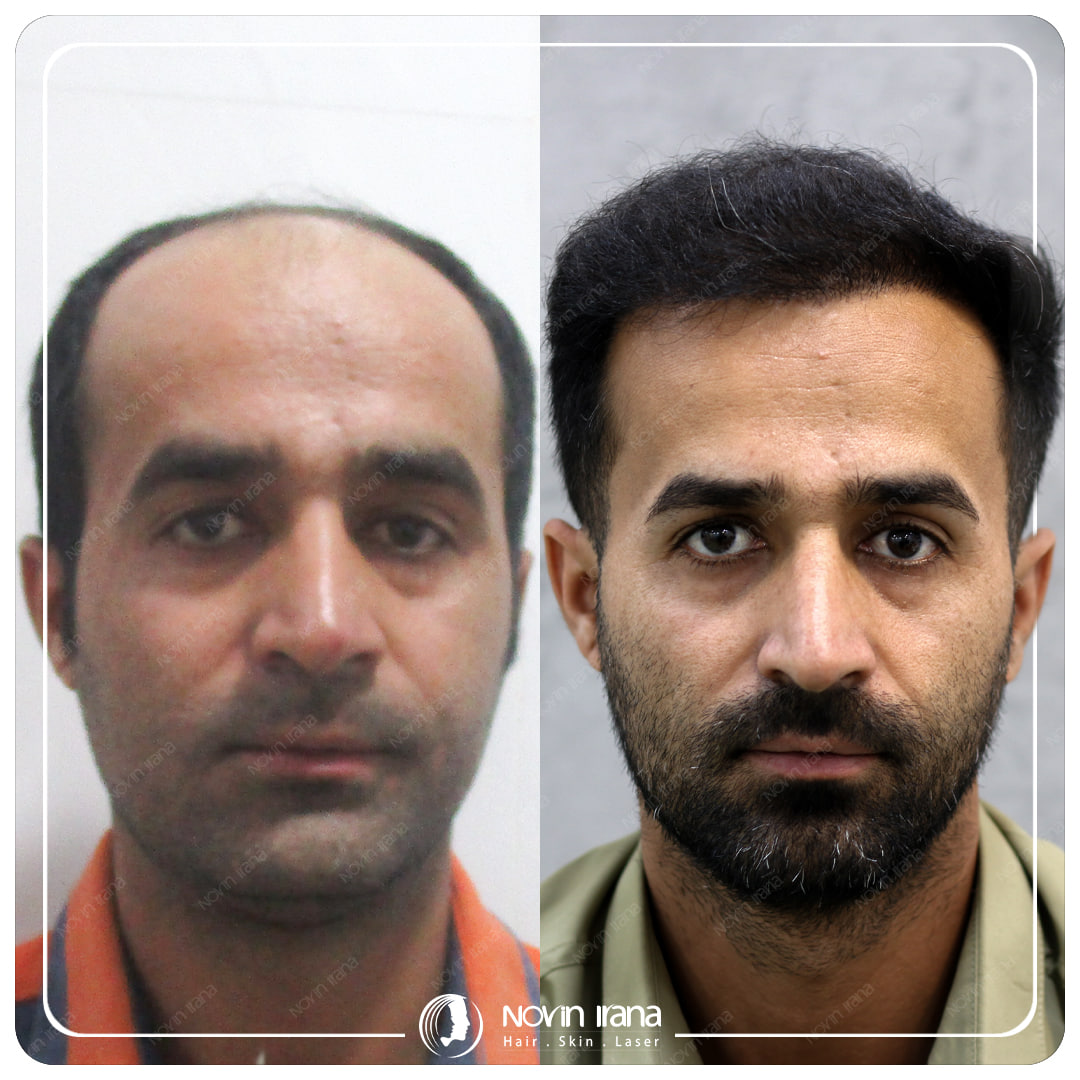 Hair Transplant