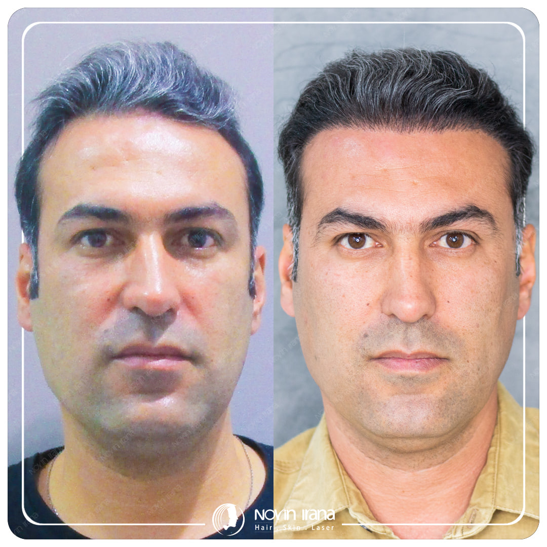 Hair Transplant