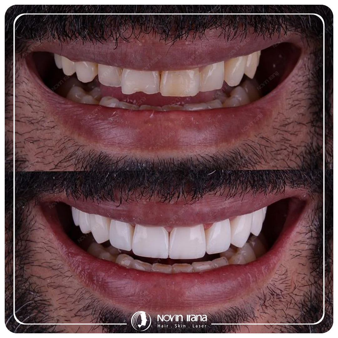 Hollywood smile