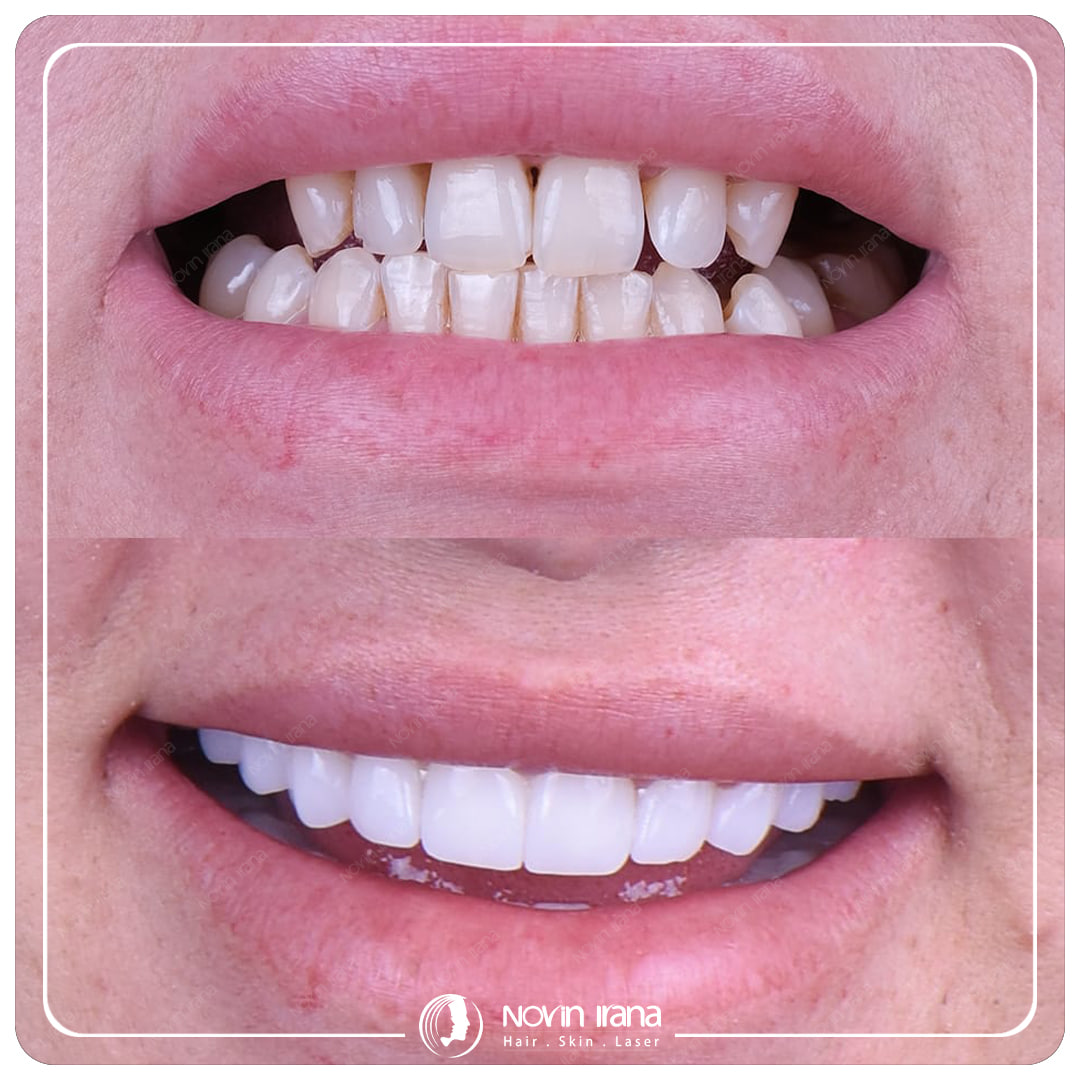 Hollywood smile