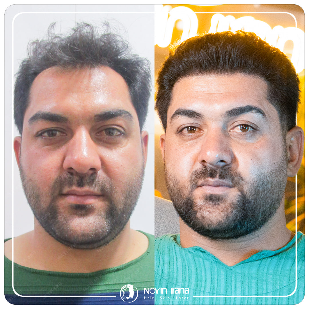 کاشت مو