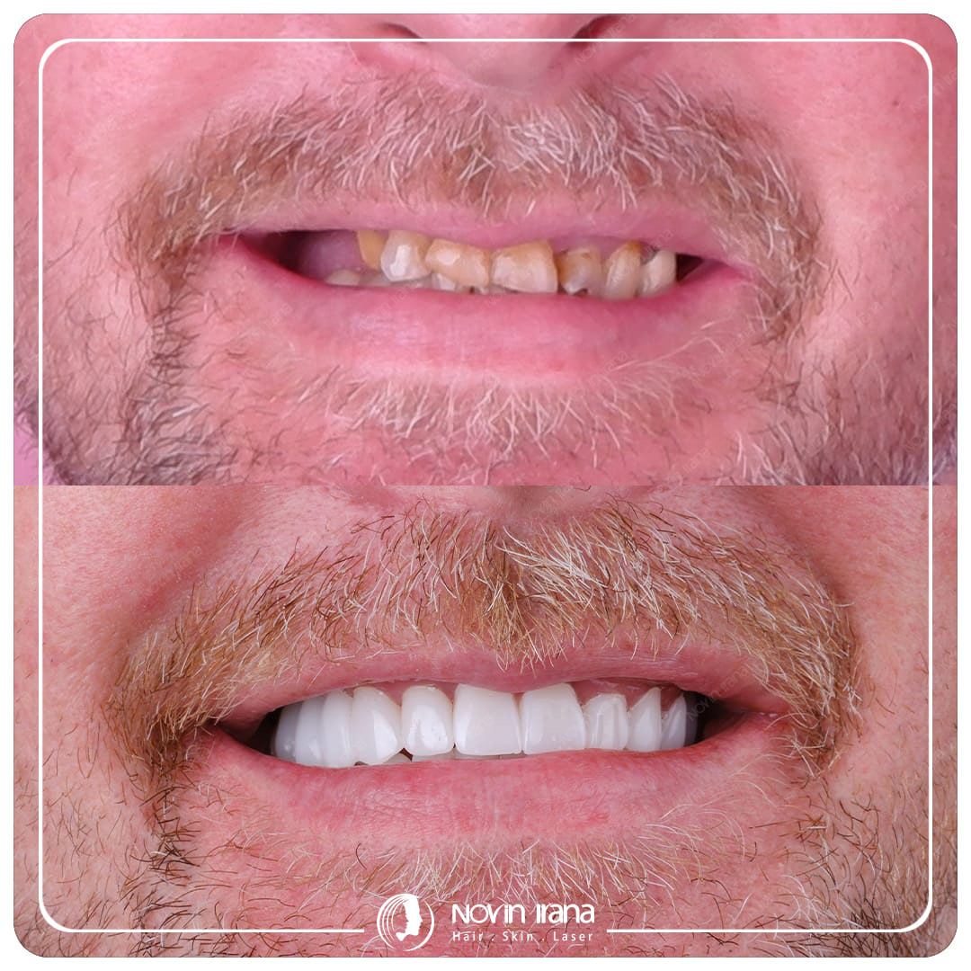 Hollywood smile
