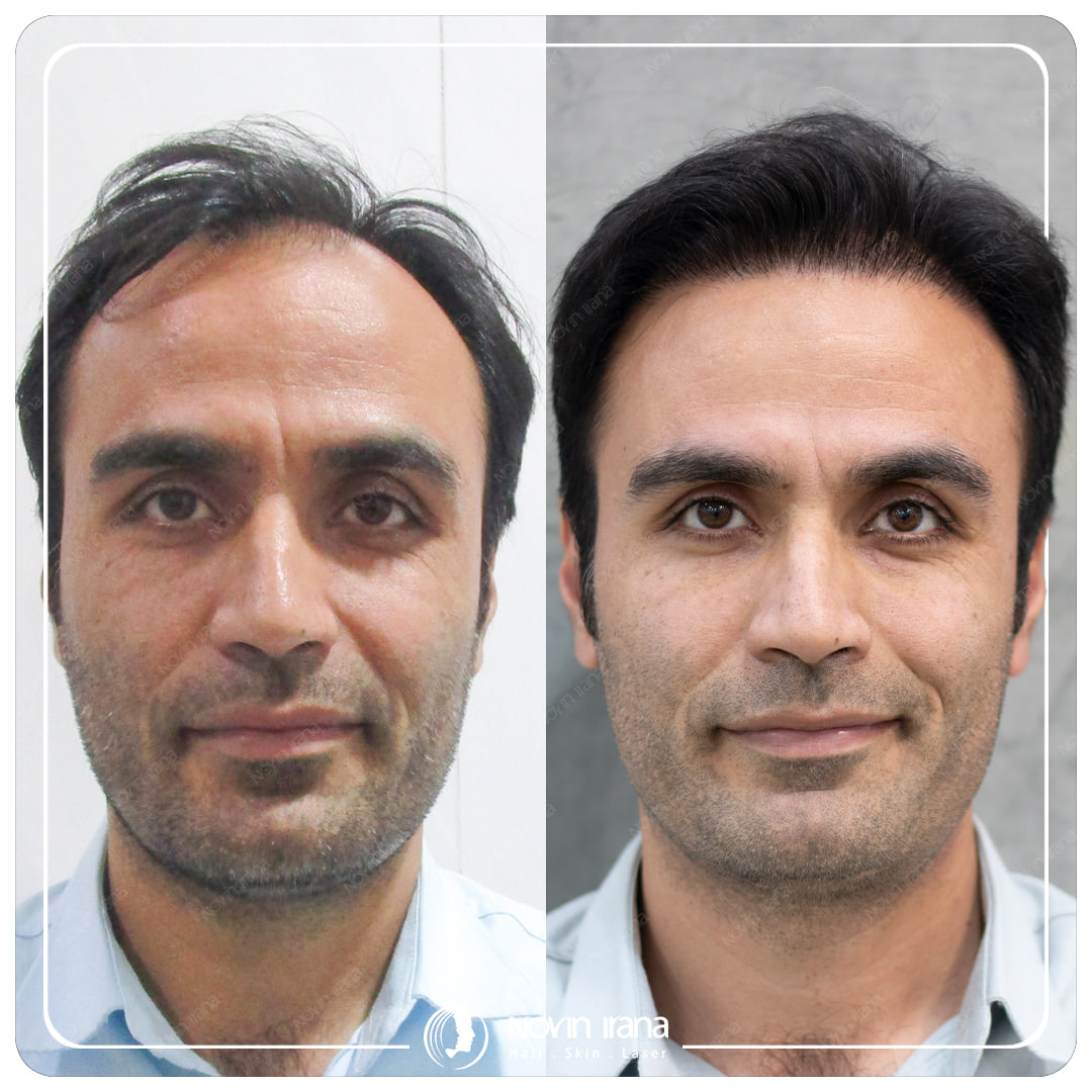 Hair Transplant