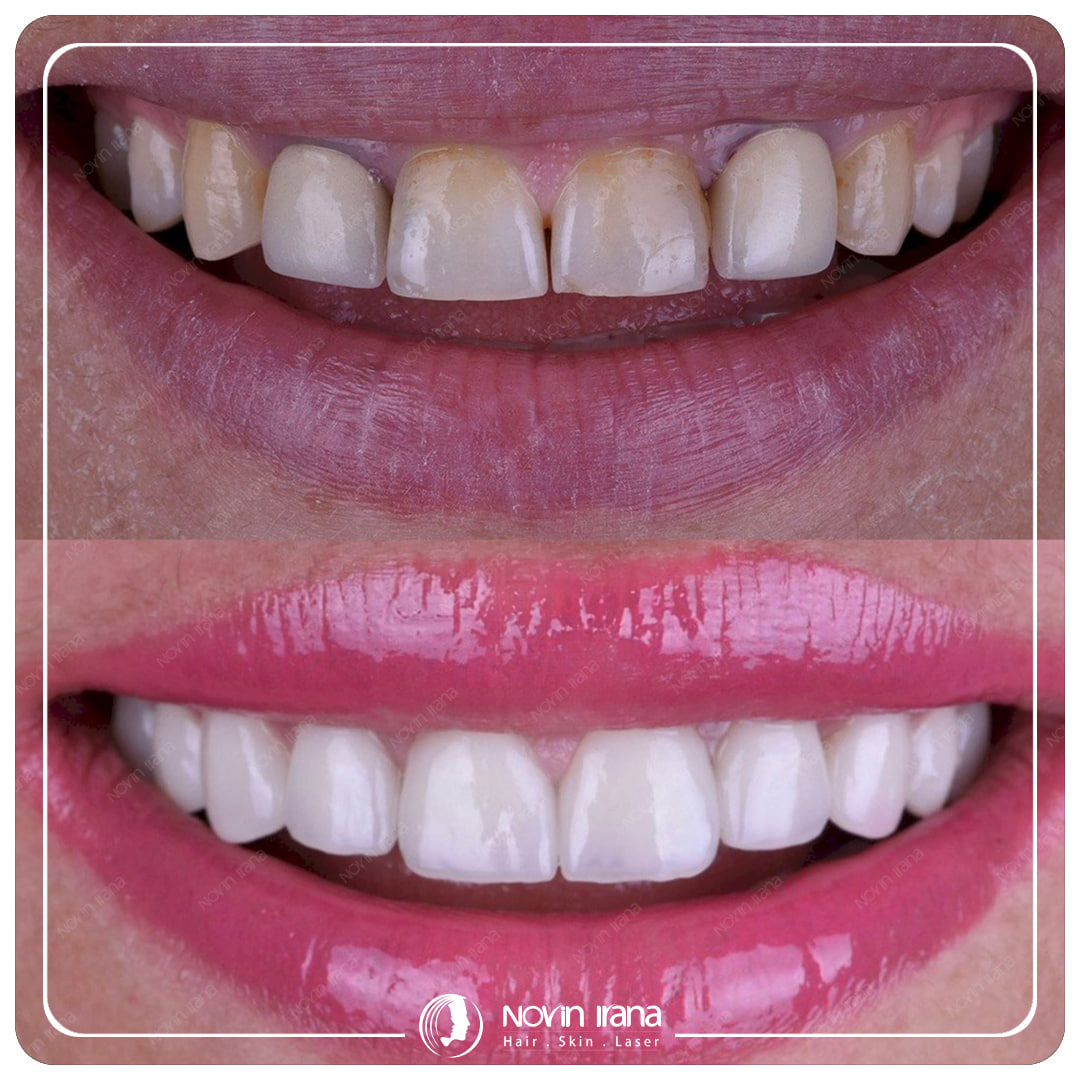 Hollywood smile