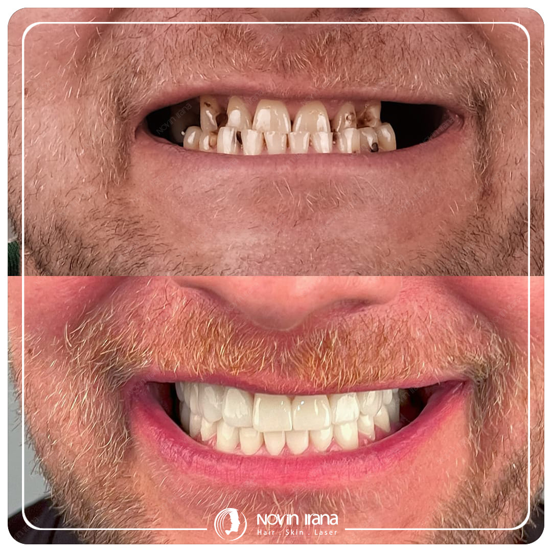 Hollywood smile