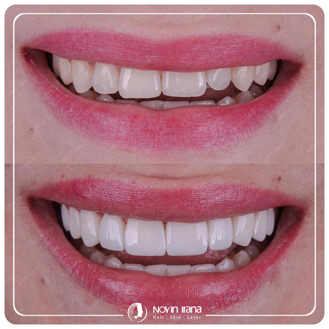 Hollywood smile