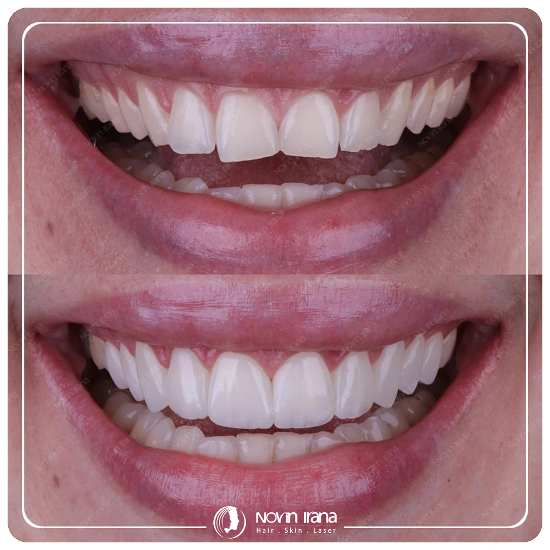 Hollywood smile