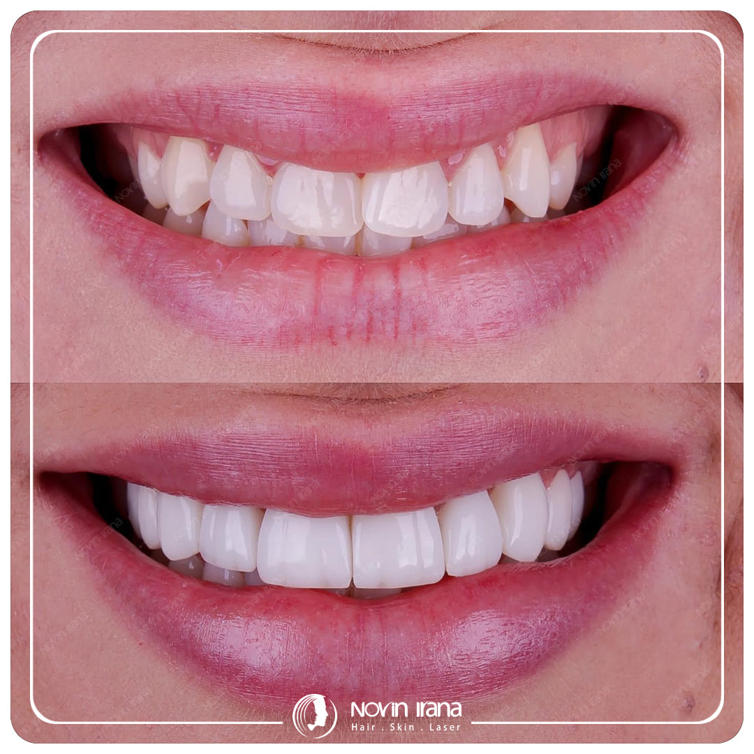 Hollywood smile