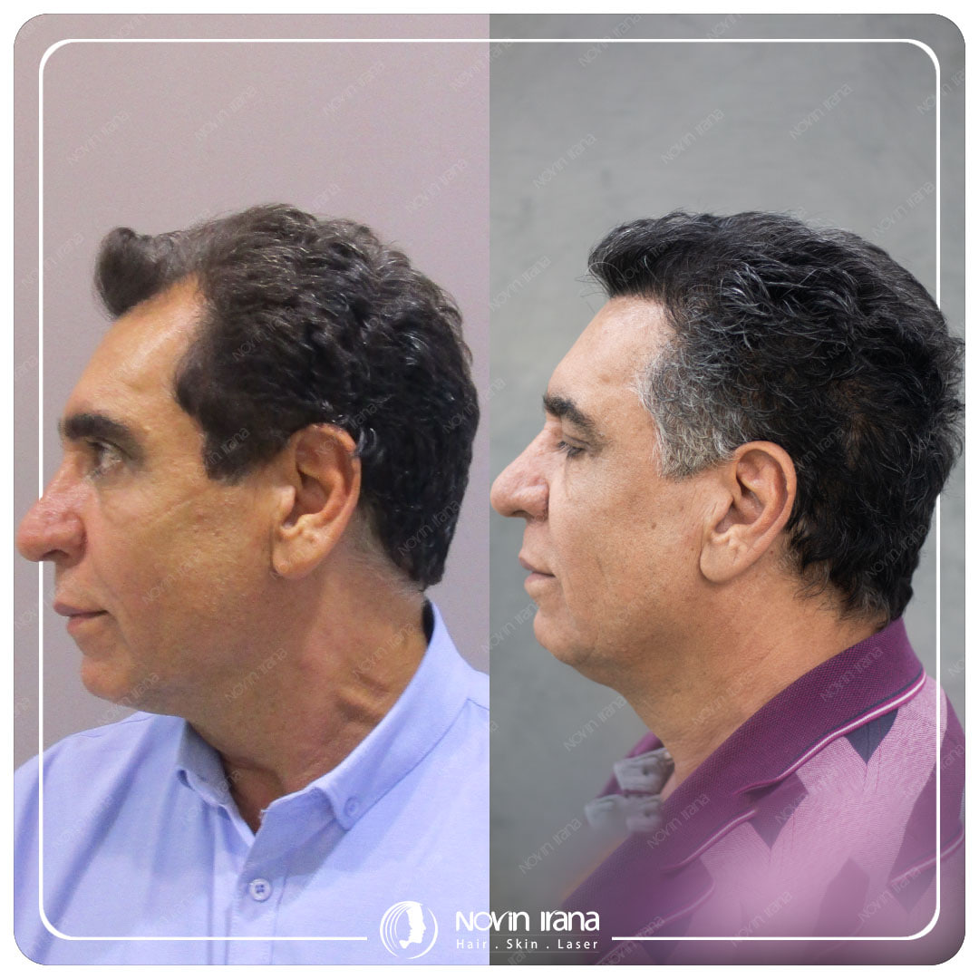 Hair Transplant