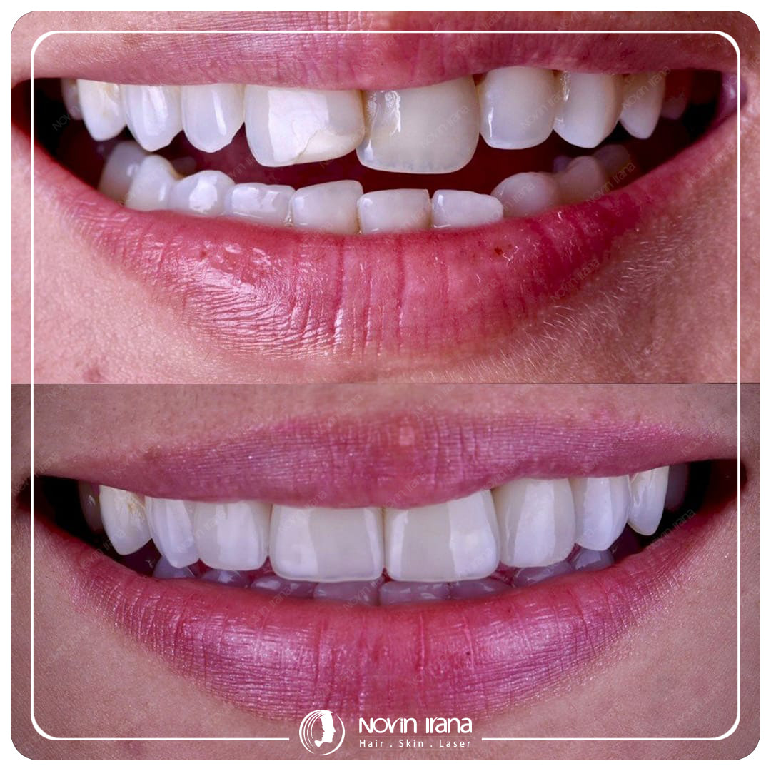 Hollywood smile