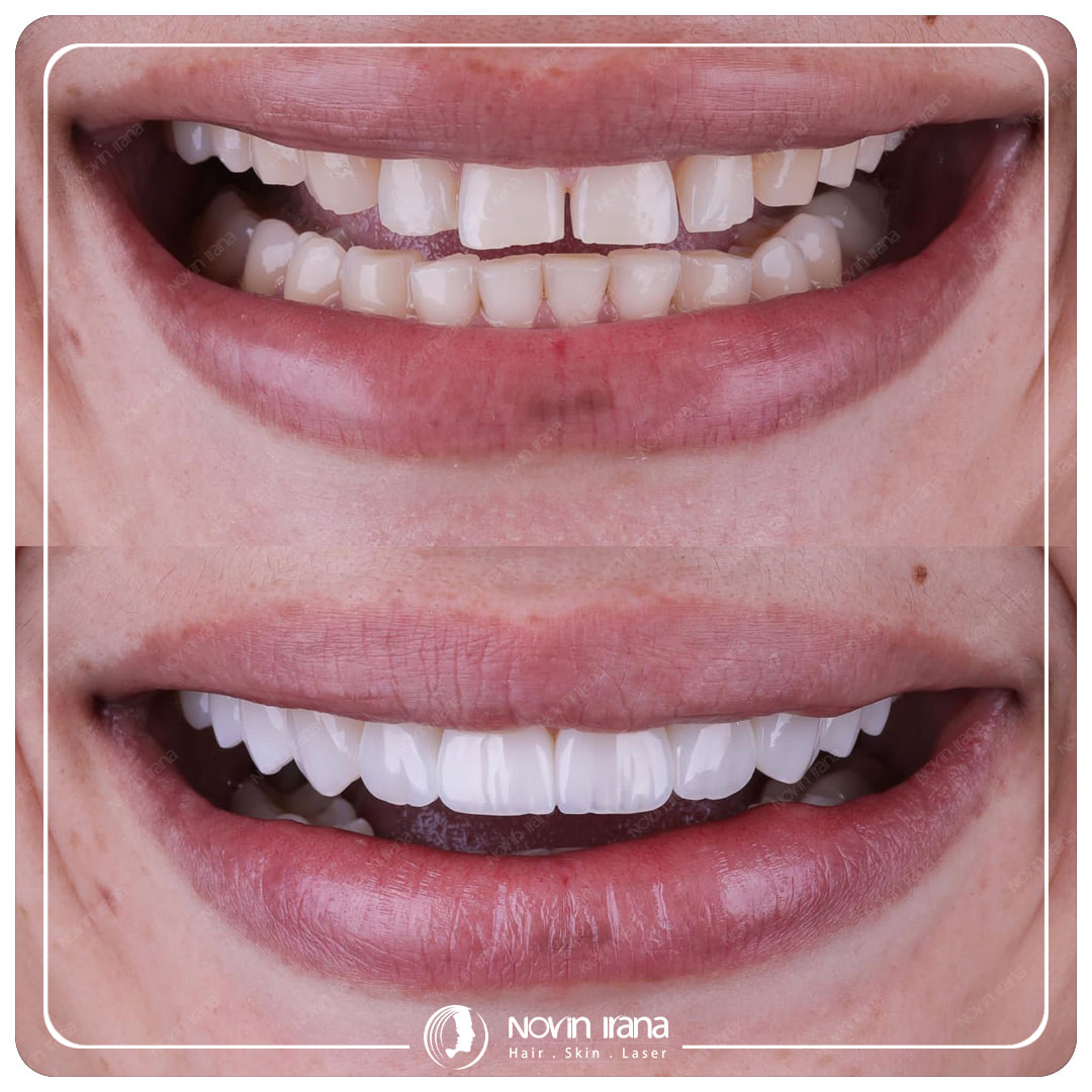 Hollywood smile