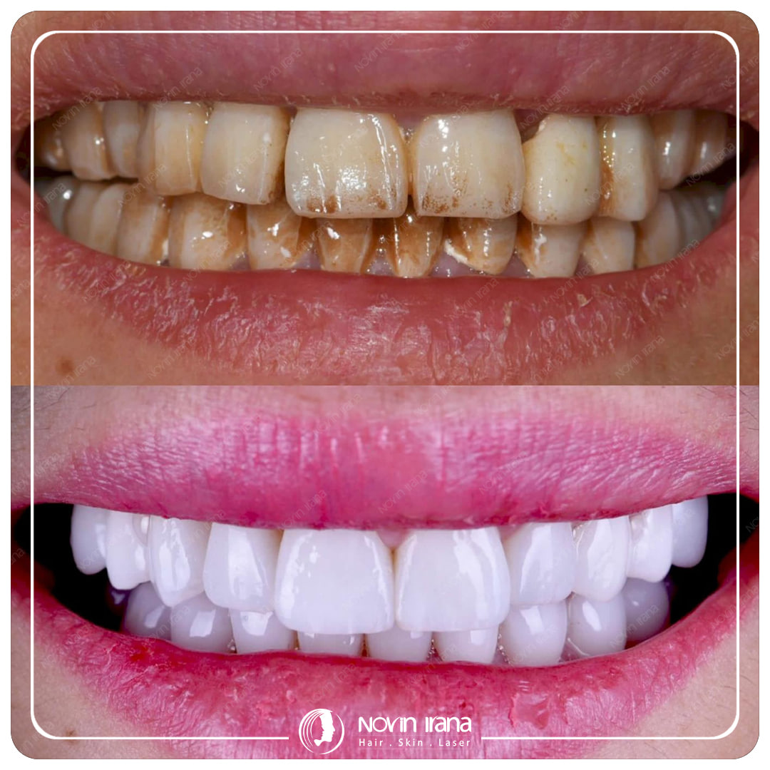 Hollywood smile