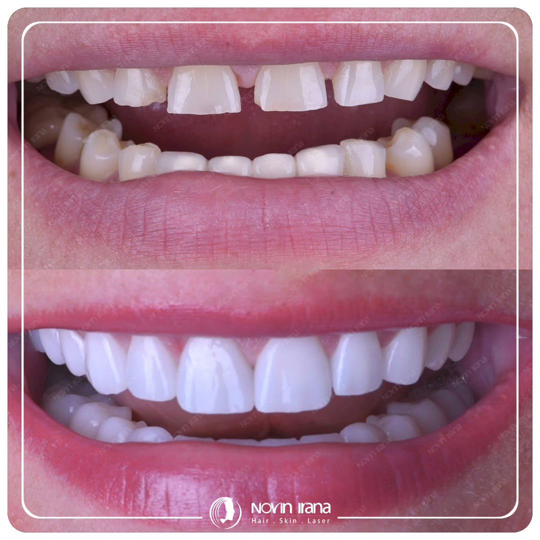Hollywood smile