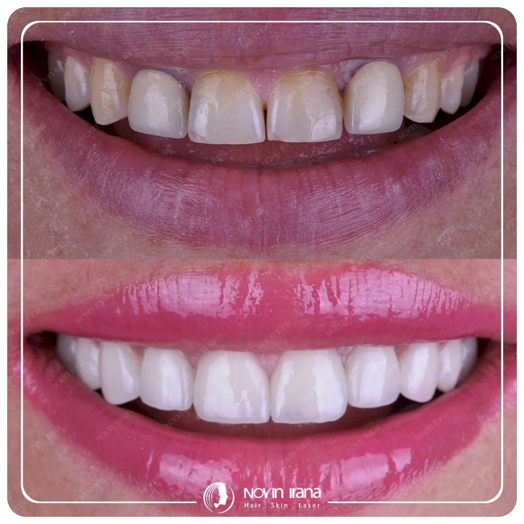 Hollywood smile
