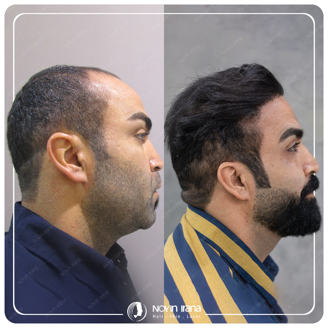 Hair Transplant