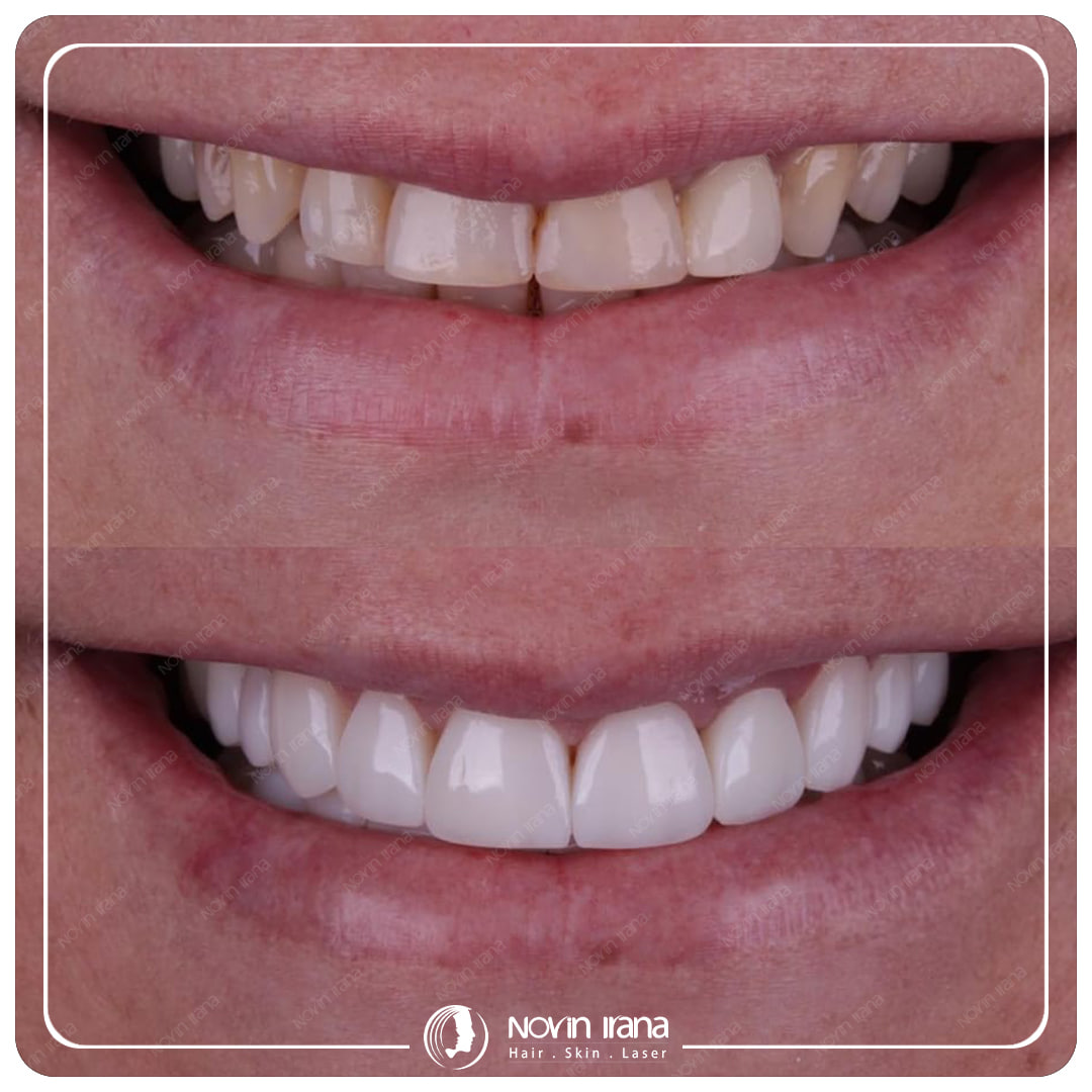 Hollywood smile