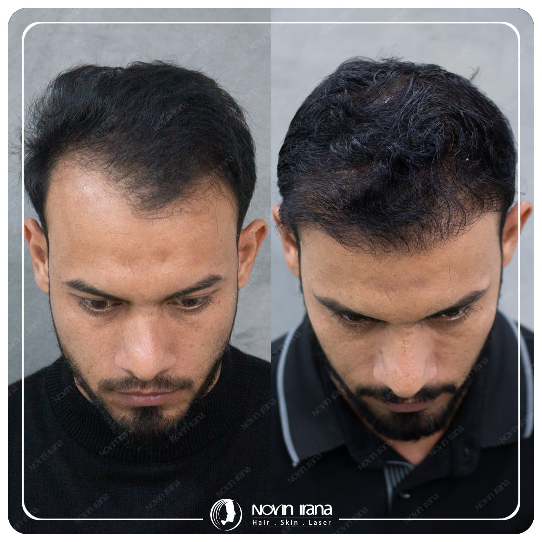 Hair Transplant