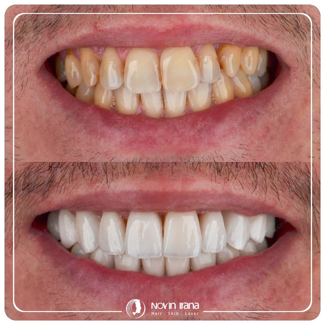 Hollywood smile