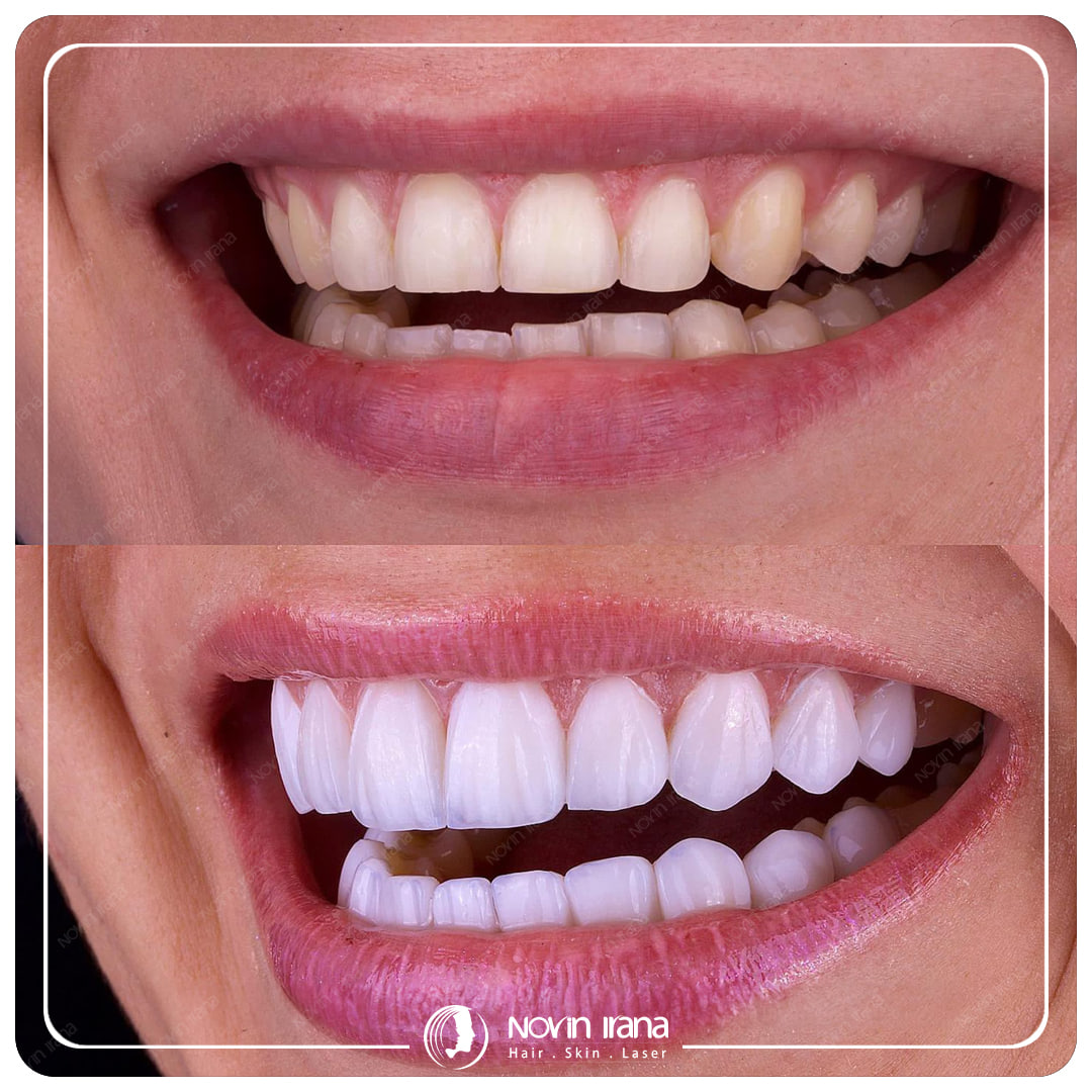 Hollywood smile
